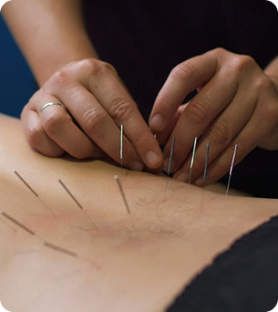 Dry Needling